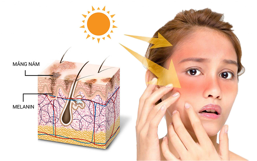  Giải đáp sạm da là gì ? Cùng với cách trị sạm da mặt đơn giản hay cách chữa sạm da và Nguyên nhân làm da dễ bị sạm, da bị sạm đen,da bị sạm màu là do tiếp xúc với ánh nắng mặt trời
