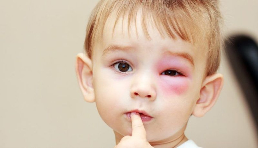 Biến chứng viêm xoang gây ảnh hưởng thị giác của trẻ con