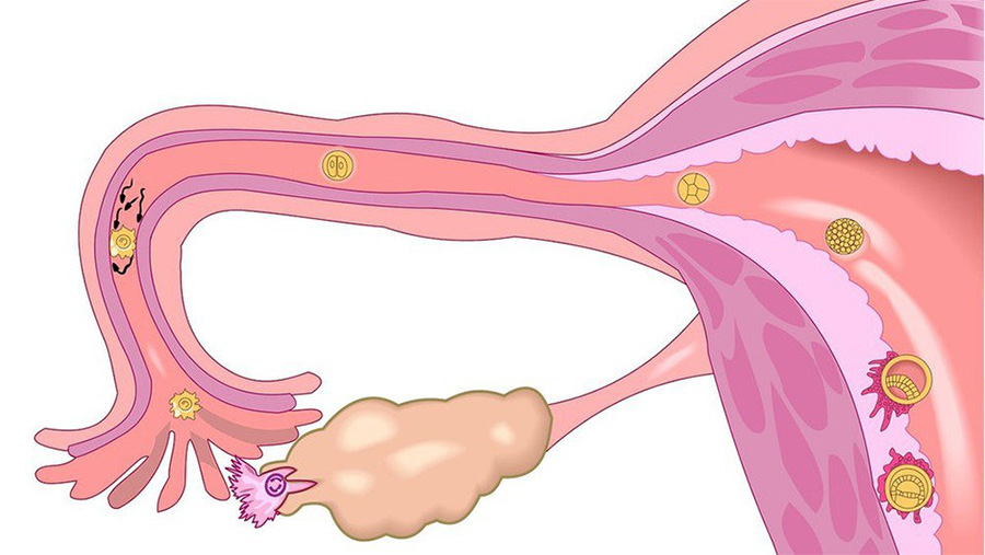 Rối loạn nội tiết buồng trứng là một trong những nguyên nhân dẫn đến nội tiết tố nữ ít đi