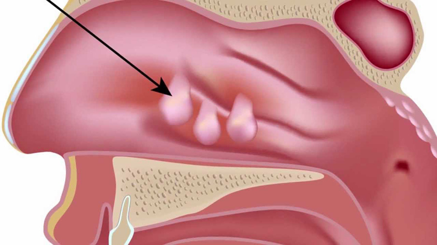 Sự xuất hiện của các khối polyp mũi là nguyên nhân gây viêm xoang mãn tính 
