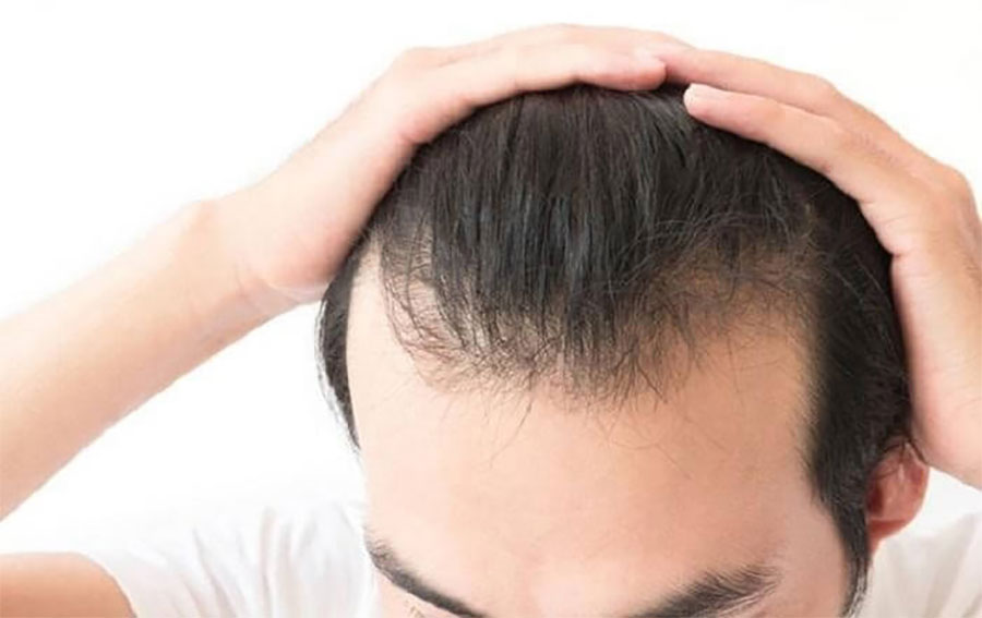 Triệu chứng rối loạn nội tiết tố nam phổ biến là bệnh rụng tóc