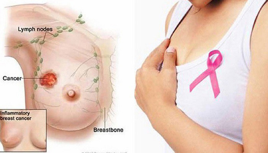 Tác dụng phụ của thuốc nội tiết làm tăng nguy cơ ung thư vú