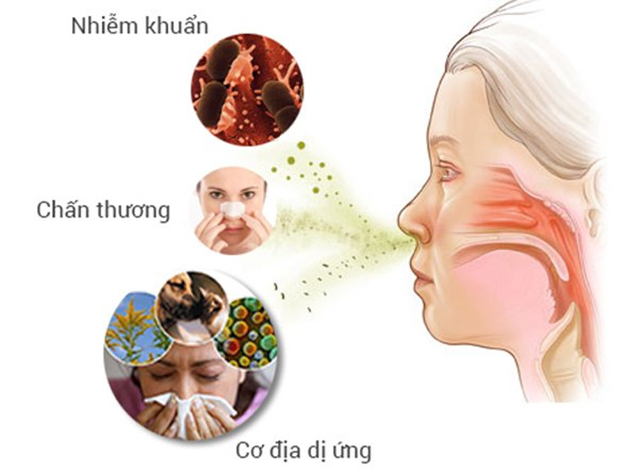 Viêm mũi dị ứng bội nhiễm có nguyên nhân gây bệnh giống như bệnh viêm mũi dị ứng thông thường